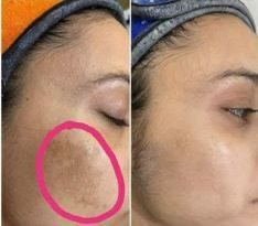 pigmentation 