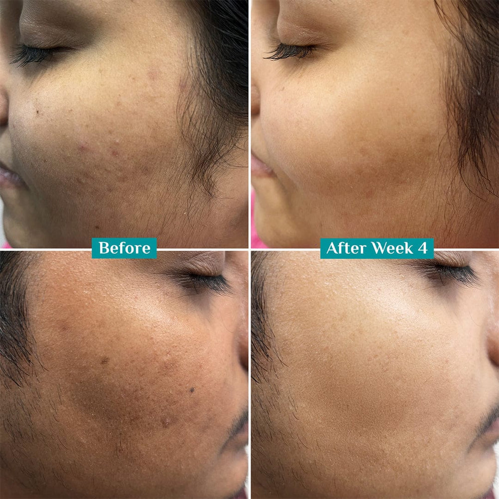 vitamin-c-face-serum-for bright dull skin